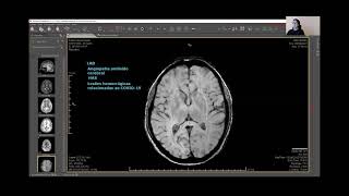 RM cerebral pósCOVID19 Discussão de dois casos [upl. by Ahsaet709]