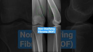 NonOssifying Fibroma bones radiology knee [upl. by Cairistiona]