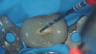 VDW Dental · Grande amp Plotino RECIPROC blue  Step by step preparation clinical video [upl. by Aynav]