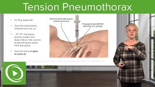 🚨 Tension Pneumothorax Critical Diagnosis amp Treatment Explained [upl. by Wasserman]