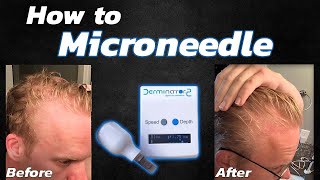 How to Microneedle for Hair Loss Using the Derminator 2 [upl. by Anwahsar]