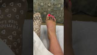 6 weeks of Lisfranc injury ORIF surgery and healing in 24 seconds [upl. by Keel]