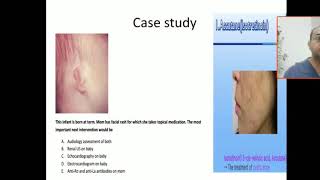 Case 70 teratogenic medication isotretinoin embryopathy retonic acid induced microtia Anotia TGA [upl. by Bo]