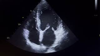 RWMADilated LA MildModerate MRMild Moderate LV Dysfunction cardio mitralregurgitation aorta [upl. by Kendell]