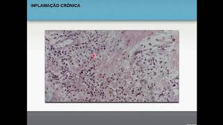 Inflamação crônica  Patologia geral 34 [upl. by Bronez]