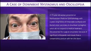 A Case of Downbeat Nystagmus and Oscillopsia [upl. by Buchheim931]