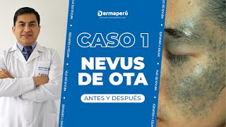 Caso 1 NEVUS DE OTA  Dermaperú  DR José Aparcana [upl. by Hillard112]