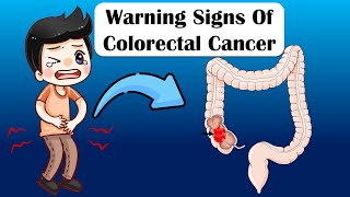 Warning Signs Of Colon Cancer  What Are The Early Signs amp Symptoms Of Colon Cancer [upl. by Otrebide60]