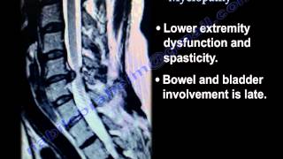 Cervical Spine Myelopathy  Everything You Need To Know  Dr Nabil Ebraheim [upl. by Gnes]