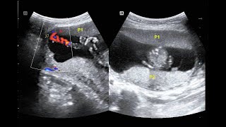 usg velamentous cord insertion in twin pregnancy [upl. by Wahs]