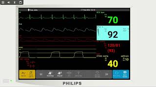 Simulated Intellivue MP30 [upl. by Asenev]