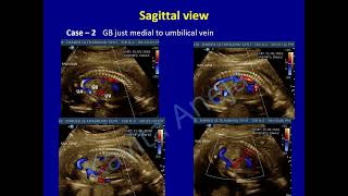 Umbilical  portal venous system and Persistent right umbilical vein [upl. by Hennebery657]