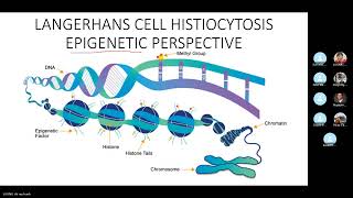 JCS 7 Langerhans cell histiocytosis [upl. by Ayk]