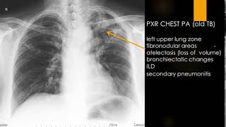 CASE 629 TB left upper lung old tuberculosis fibronodular areas [upl. by Normak]