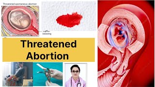 Threatened AbortionSecond Trimester Abortionsymptoms of AbortionDr Naima Bano Shifa Clinic [upl. by Corbet]