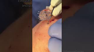 Deep Acne Scars  Ice Pick Scar Treatment [upl. by Eelarual]