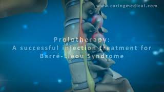 3D animation demonstrating Prolotherapy for BarréLiéou Syndrome and cervical spine instability [upl. by Yenduhc]