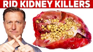 Clean Your Kidneys of Uric Acid and Oxalates [upl. by Oly]