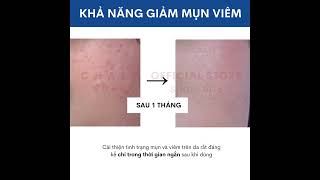 Review Tinh chất dưỡng serum trị mụn Meishoku Bigan Acne Essence 15g Nhật  Shop Nhật Chaly [upl. by Hernando873]