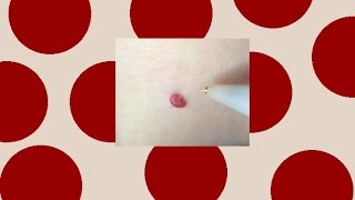 Cherry Angioma Removal [upl. by Ritter82]