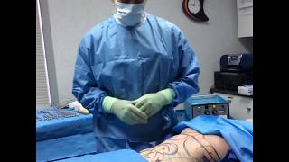 Reverse Abdominoplasty amp LipoSculpture of Abdomen Part 1 [upl. by Jamin]