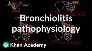 Bronchiolitis pathophysiology  Respiratory system diseases  NCLEXRN  Khan Academy [upl. by Attenat]