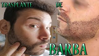 TRASPLANTE DE BARBA [upl. by Caren]