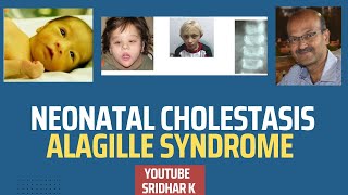 Alagille syndromewhat is Watson Alagille Syndrome neonatalcholestasis alagillesyndrome [upl. by Jeremy]