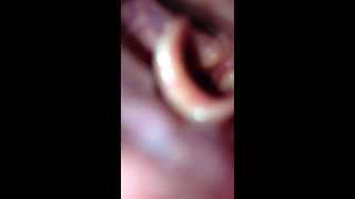 Vocal Folds with iPhone [upl. by Iand]