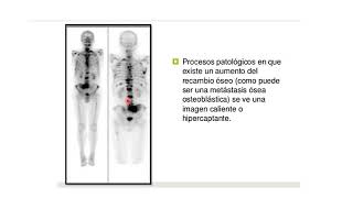 medicina nuclear y gamagrafía ósea [upl. by Reinal]