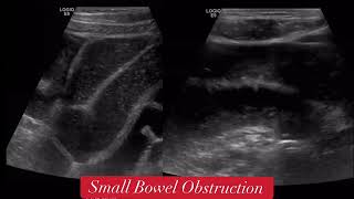 Small Bowel Obstruction [upl. by Wiggins]