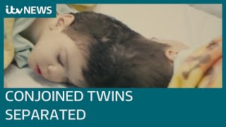 Conjoined twins with fused brains successfully separated with help of British surgeon  ITV News [upl. by Namolos]