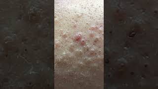 Lets Count Acnes  ACNE TREATMENT MAI NGOC FAMILY 💕💕  ACNE TREATMENT MAI NGỌC  demo [upl. by Airdnekal]