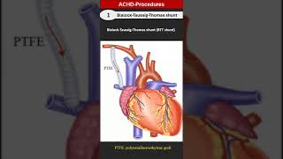 ACHD Procedures 1 BlalockTaussig shunt [upl. by Woodford]