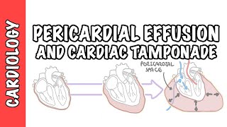 Cardiac Tamponade  pericardial effusion causes pathophysiology investigations and treatment [upl. by Slen108]