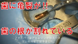 歯にヒビが！歯の根の亀裂！歯根破折！Endodontics  Root Canal Treatment [upl. by Alekehs]