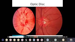 Fundoscopy and Eye Examination [upl. by Melan]