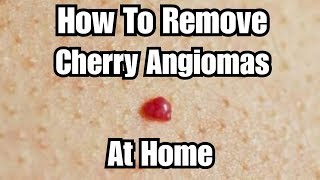 DIY Removing Cherry Angiomas at Home [upl. by Oilejor]