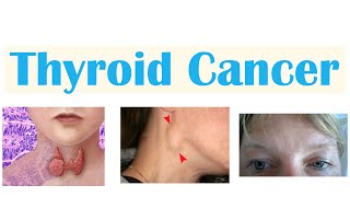 Thyroid Cancer Papillary Follicular Medullary amp Anaplastic  Symptoms Diagnosis Treatment [upl. by Ttessil]