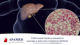 Esteatosis hepática asociada a disfunción metabólica MASLD NAFLD [upl. by Devad482]