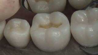 Class I Composite Preparation amp Restoration  Operative Dentistry [upl. by Aztinaj]