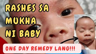 RASHES SA MUKHA ni baby NEONATAL ACNE REMEDY by Dr Pedia Mom [upl. by Frederick]