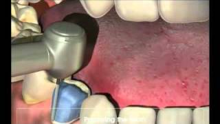 Crowns  Procedure for your new crown at Dental Reflections [upl. by Nosredneh]