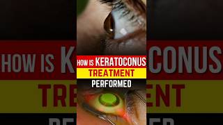 How is Keratoconus Treatment Done  Keratoconus Treatment Explained [upl. by Nessi]