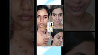 How to Use Face Peeling Serum Correctly ✅ skincare acne [upl. by Iddet]