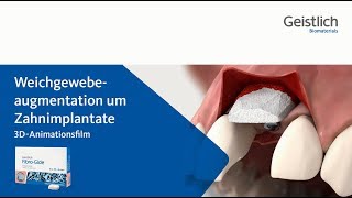 Geistlich FibroGide®  Weichgewebeaugmentation [upl. by Anirtac550]