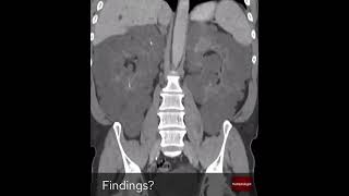 Coronal slices of an abdominal CT From The Radiologist [upl. by Aerdna35]