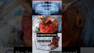 Case of Odontogenic keratocyst  OKC  Cyst of jaw  cystic lesion of jaw  Mandible Ressection [upl. by Leandre390]