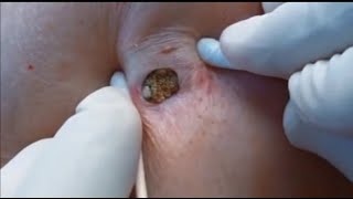 Blackheads Removal  Big Blackhead Removing  Huge Blackhead Behind The Ear [upl. by Greenwell]