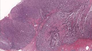 Colon Adenocarcinoma  Microscopic Diagnosis and Molecular Testing [upl. by Charlot]